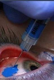 øyetatovering: fluorescerende tatovering på øyet