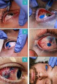 proceso de tatuaje del globo ocular